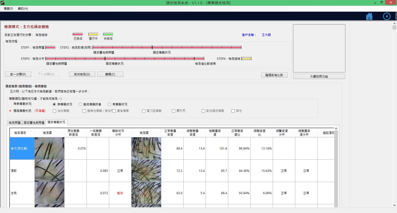 頭皮檢測取樣分析